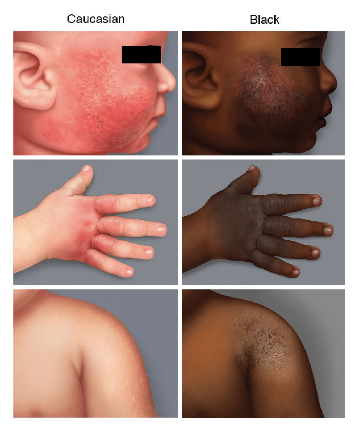 Recognising clinical signs and symptoms on black, asian and minority ...
