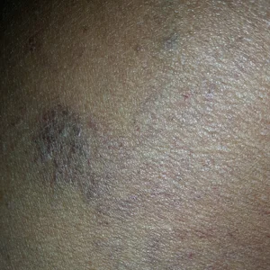 Recognising clinical signs and symptoms on black, asian and minority ...