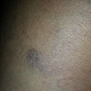 Recognising clinical signs and symptoms on black, asian and minority ...