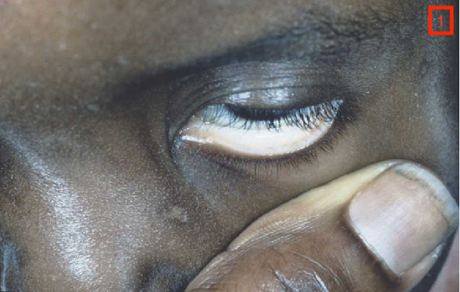 Pallor Eye Anemia Symptoms