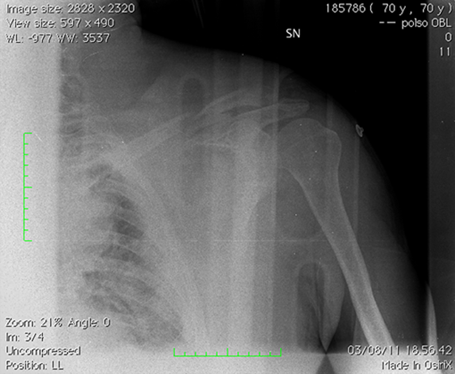 XR showing # clavicle