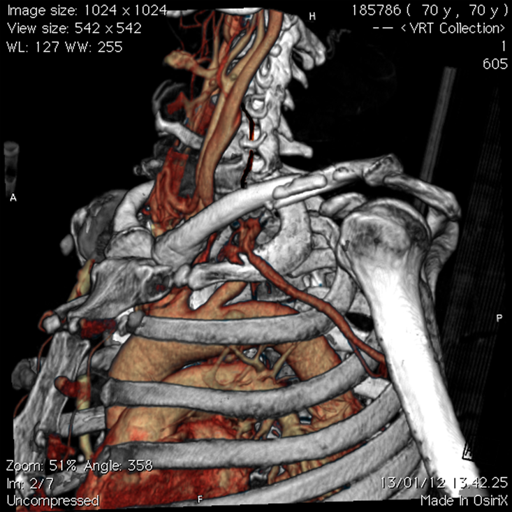 Clavicular CT Scan