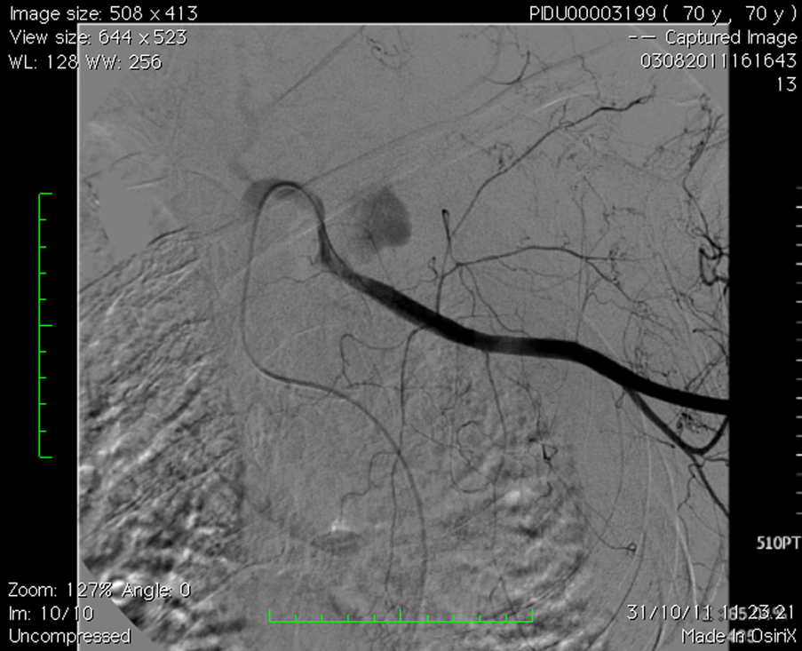 left subclavian arterial bleeding, 3 cm after homolateral vertebral artery.