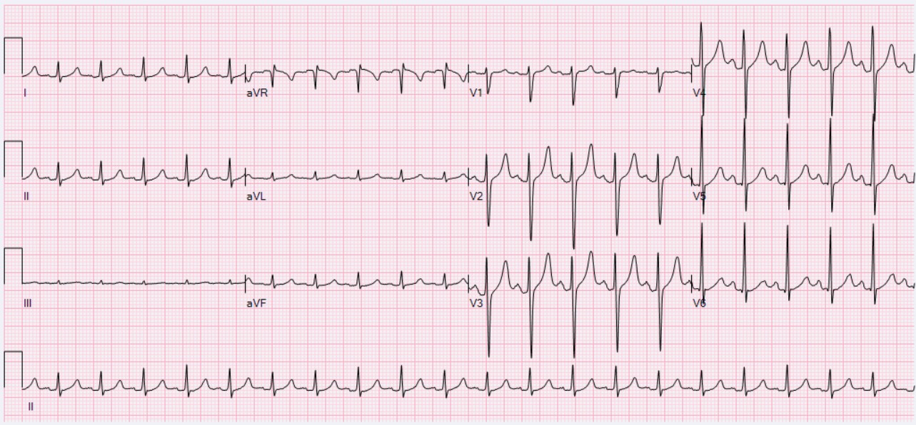 Sinus Tachycardia - PT: R.Peel